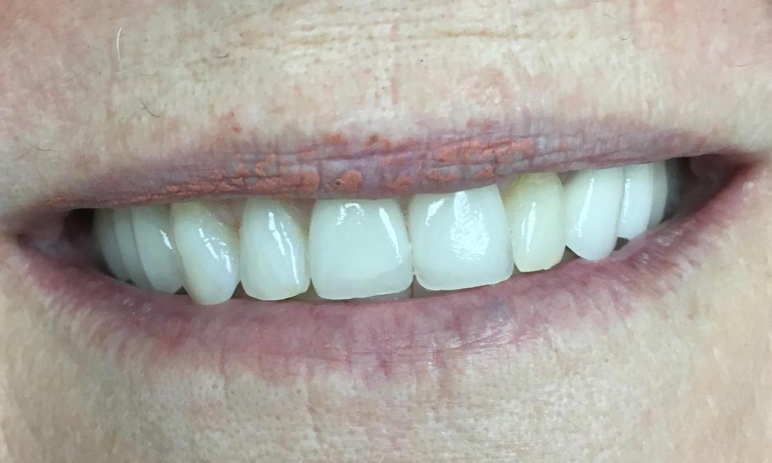 woman with new dental crowns in lake balboa