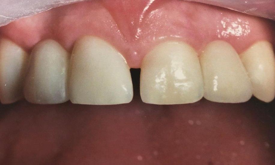 Dental Bridges in Van Nuys