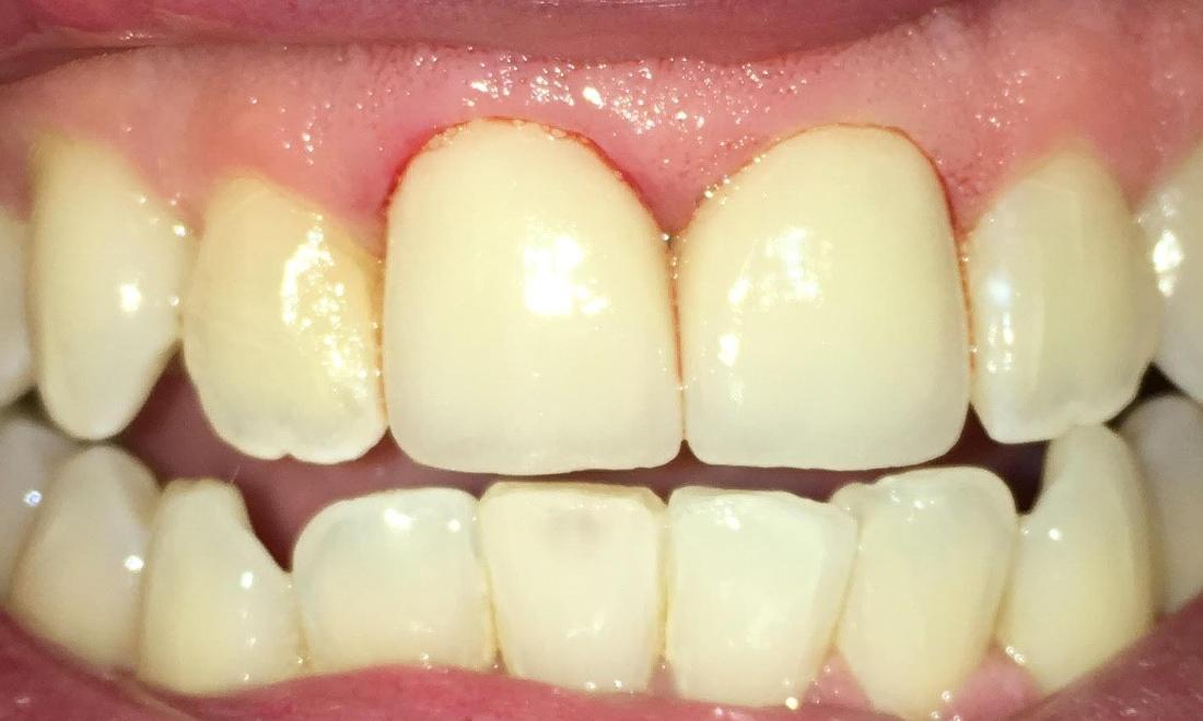 Teeth Whitening in Van Nuys