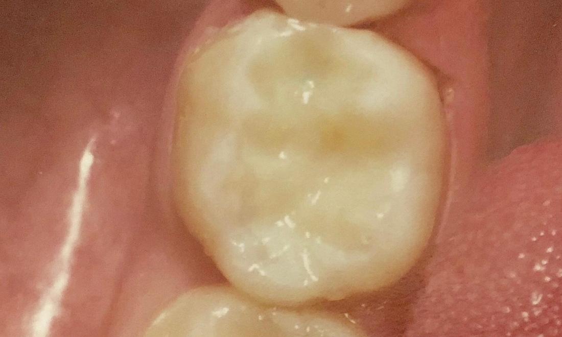 Tooth-Colored Fillings in Van Nuys | After