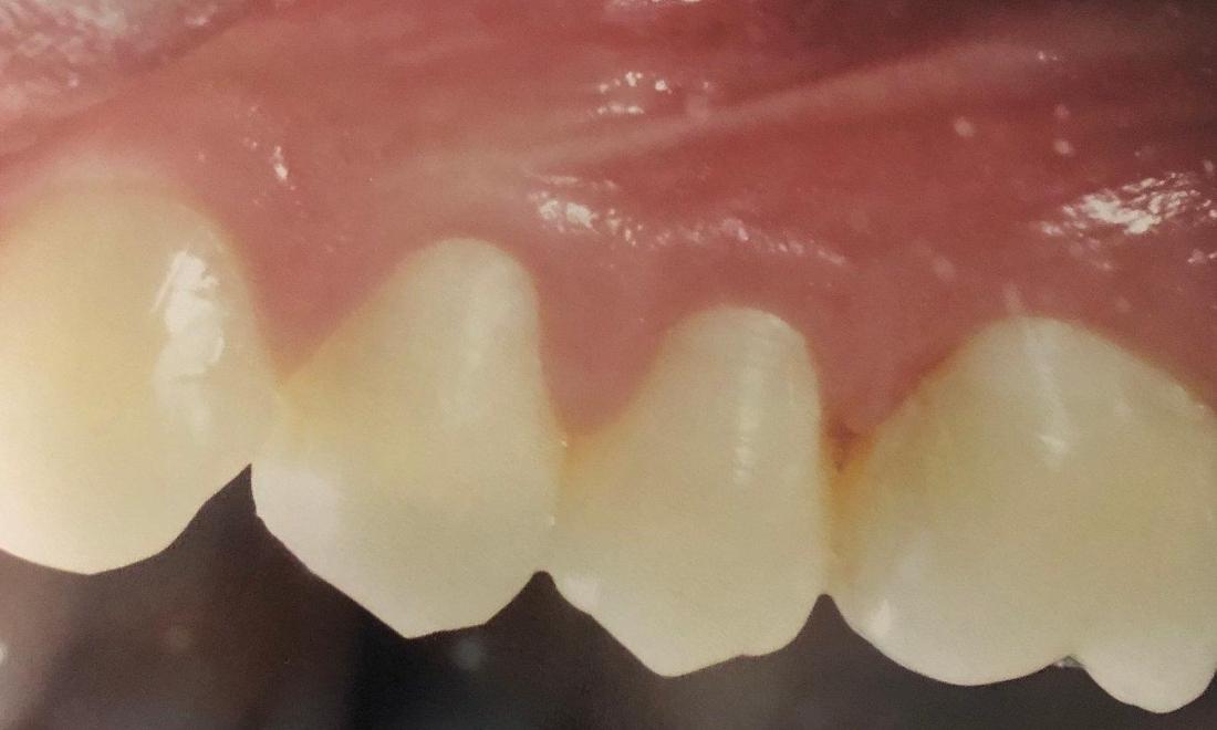 patient with tooth bonding in lake balboa