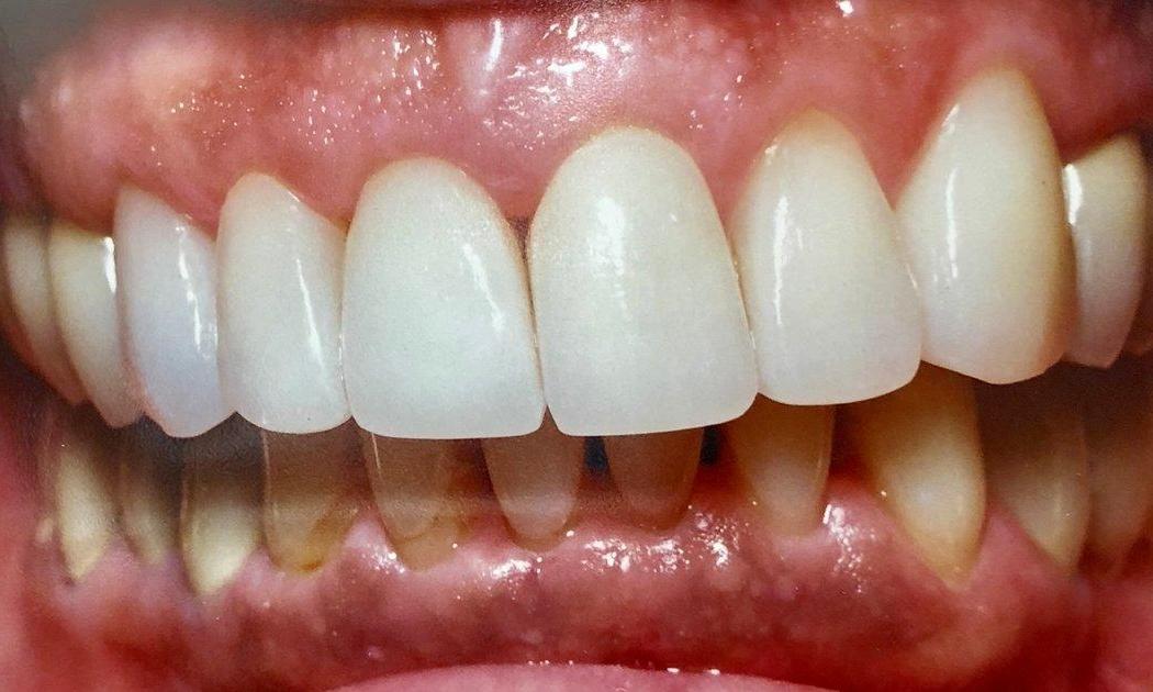 Dental Restorations with Crowns in Van Nuys | After