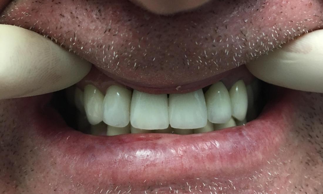patient with new dental implant in lake balboa