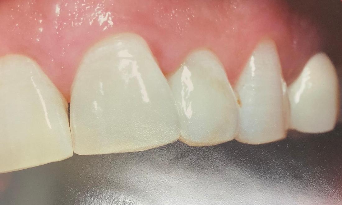 White Fillings in Van Nuys 