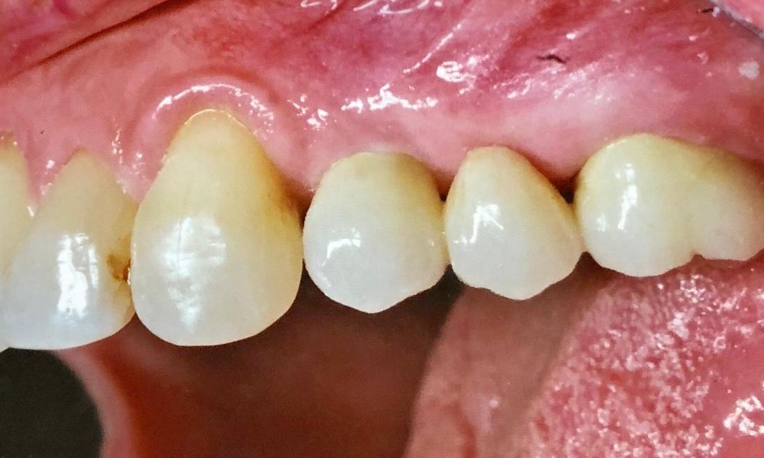 Tooth Restorations in Van Nuys | After