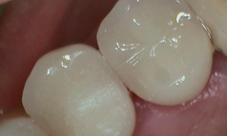 patient with tooth colored fillings in lake balboa