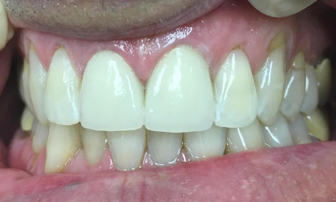 patient with new dental crowns | Lake Balboa Dentist