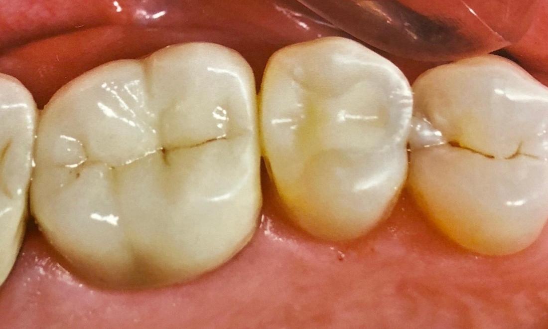 White Filling Replacement in Van Nuys | Before