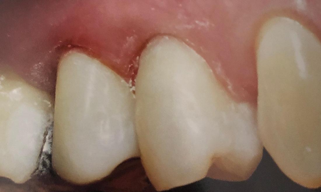 patient with new dental bonding in lake balboa