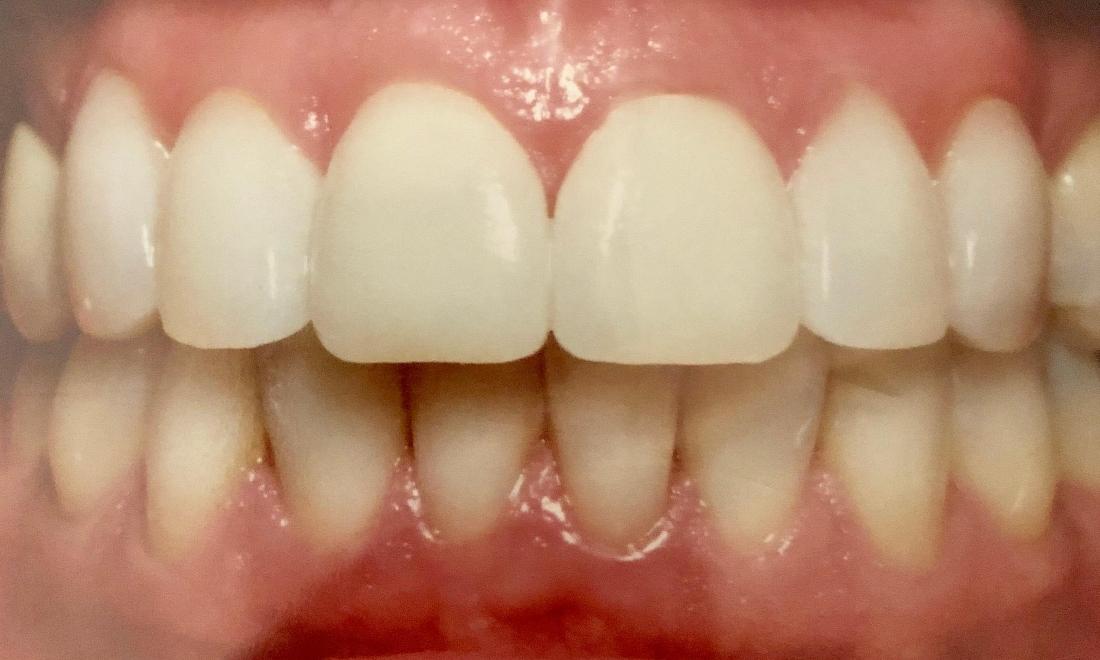 Smile Makeovers in Van Nuys | After