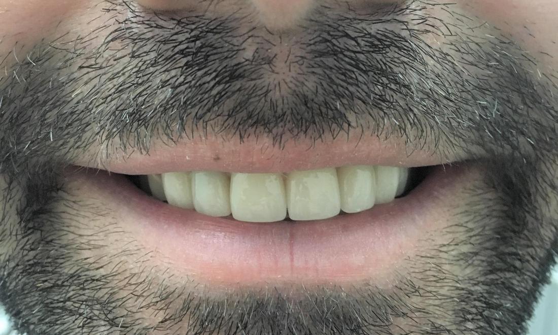 man with new dental crowns in lake balboa