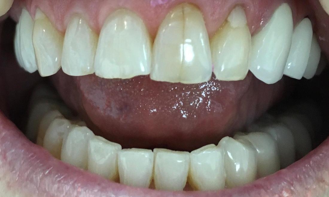 patient before dental crowns in lake balboa