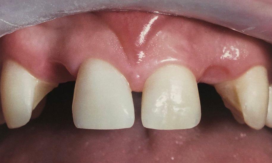 Dental Bridges in Van Nuys