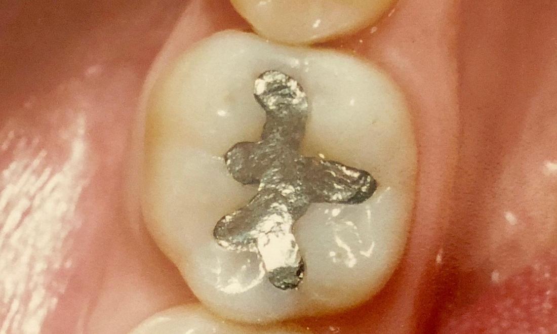 Tooth-Colored Fillings in Van Nuys | Before