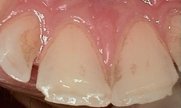 Dental Bonding in Van Nuys | Before