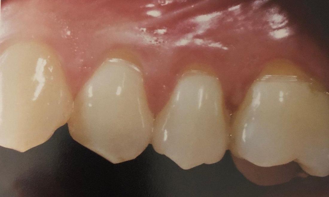 patient before tooth bonding in lake balboa
