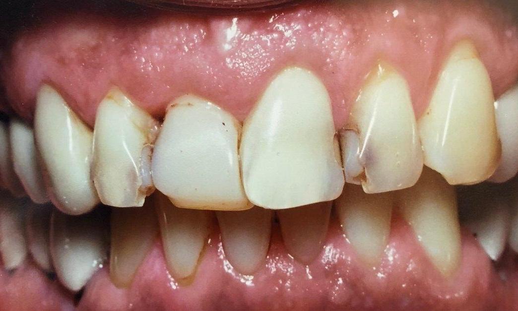 Dental Restorations with Crowns in Van Nuys | Before