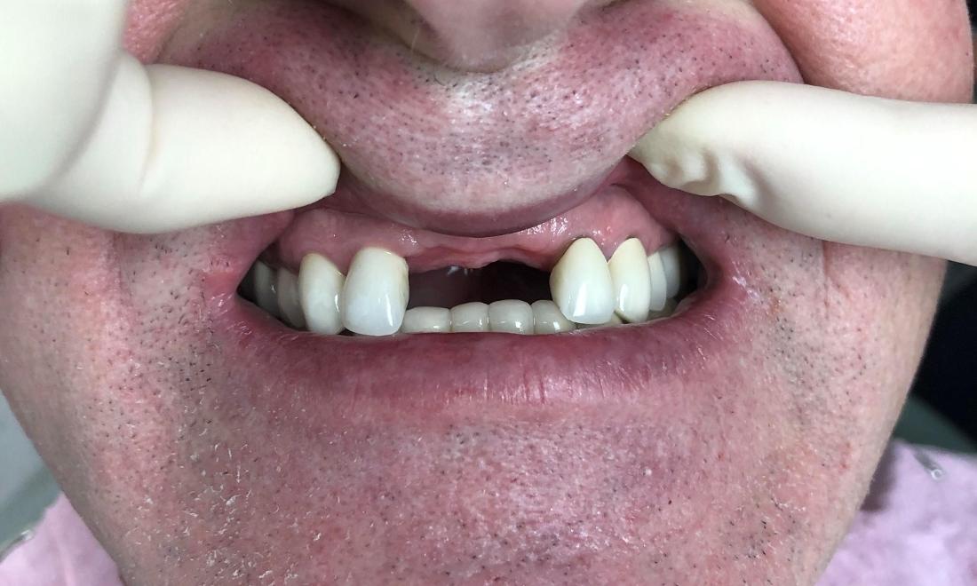 Patient with missing teeth in lake balboa