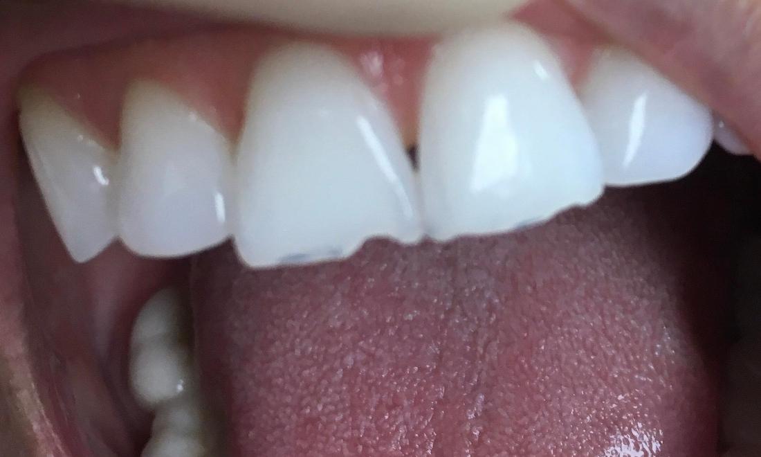 Emergency Cosmetic Bonding in Van Nuys | Before