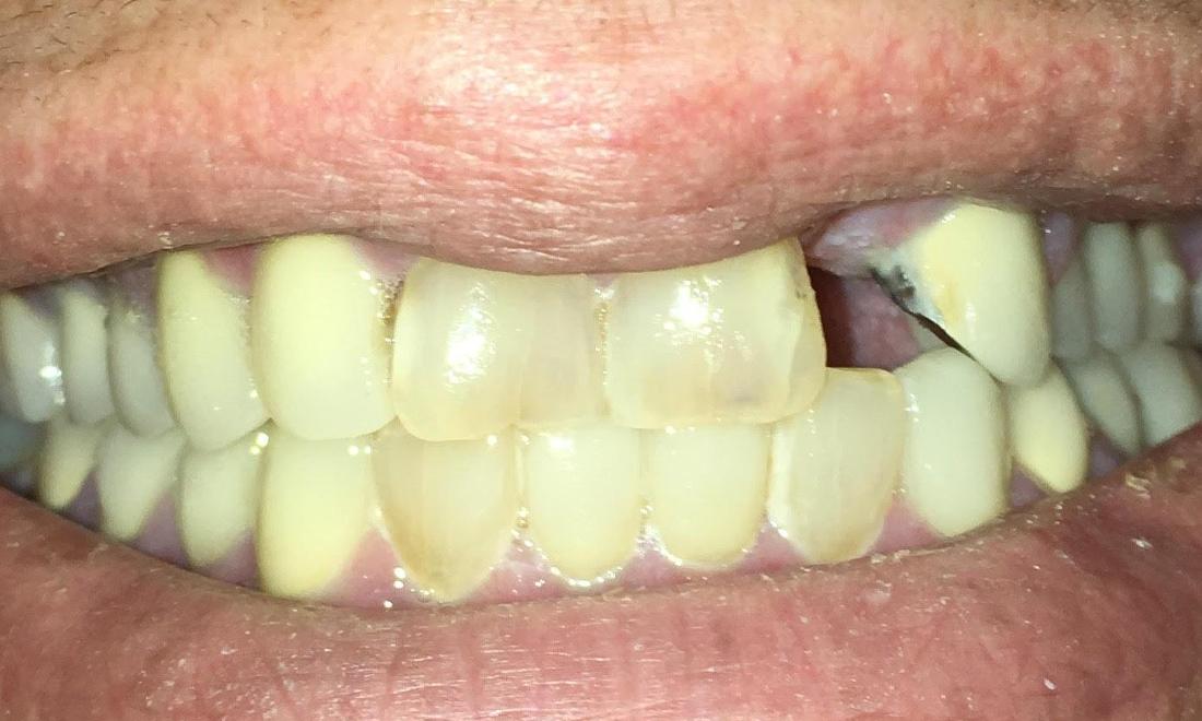 Dental Crowns in Van Nuys CA