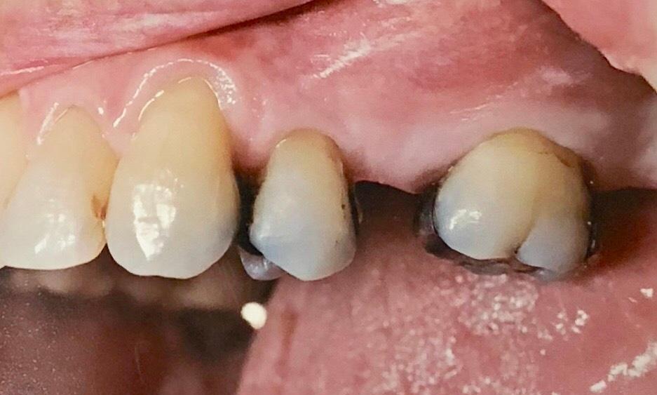 Tooth Restorations in Van Nuys | Before