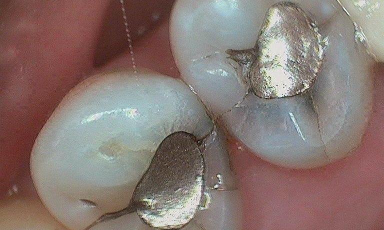 patient with silver crowns in lake balboa
