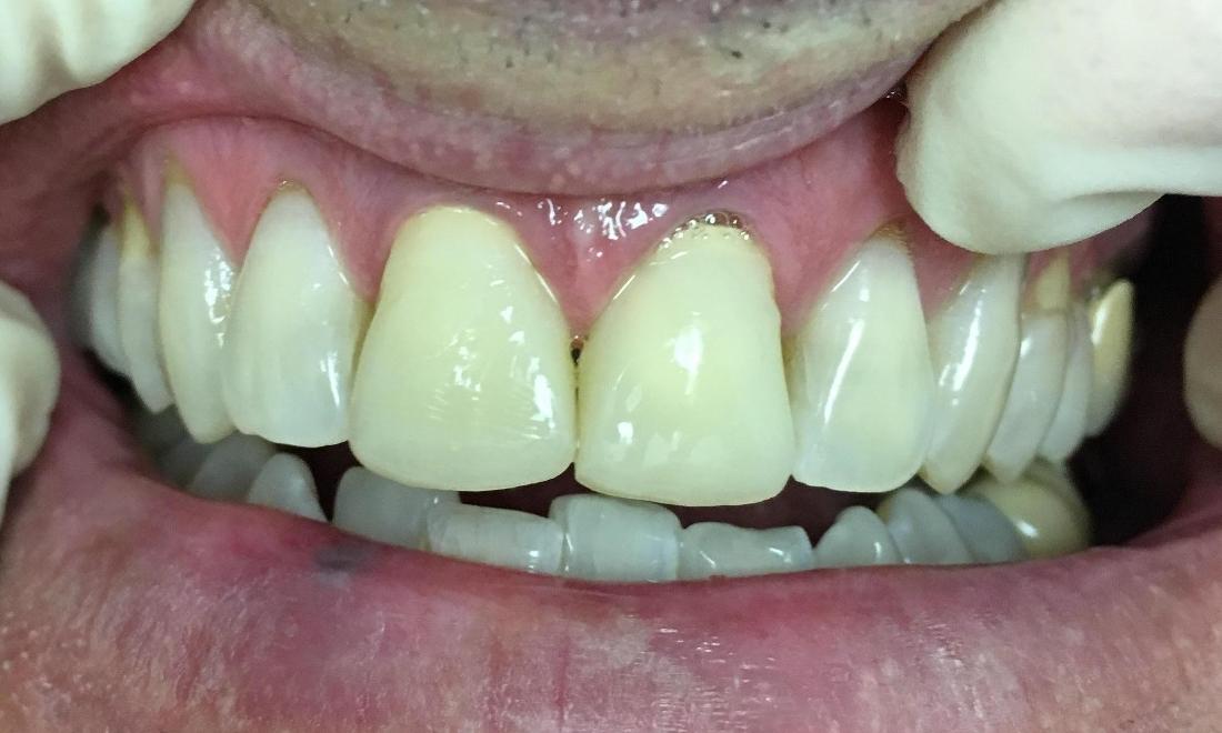 patient before new crowns | Lake Balboa Dentist