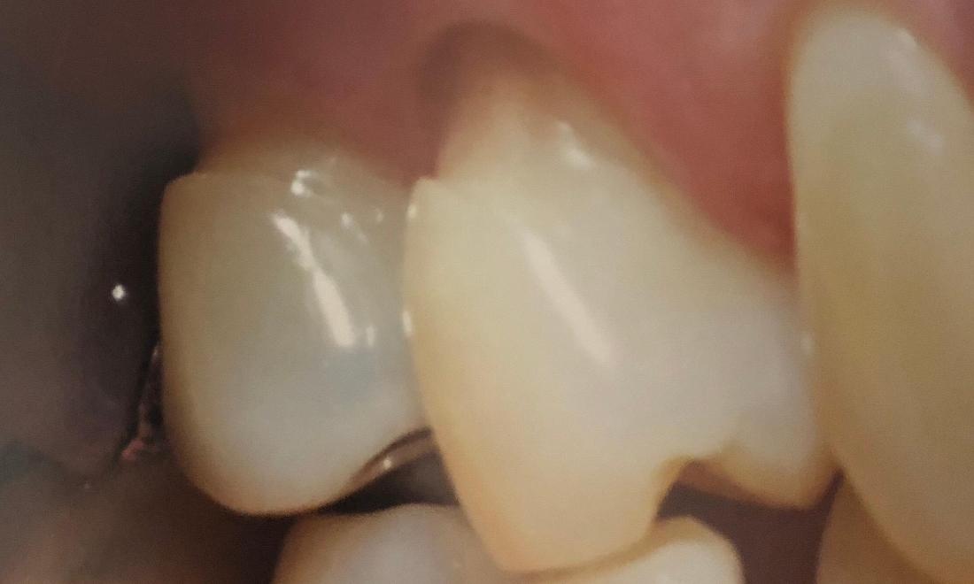 patient in need of dental bonding in lake balboa