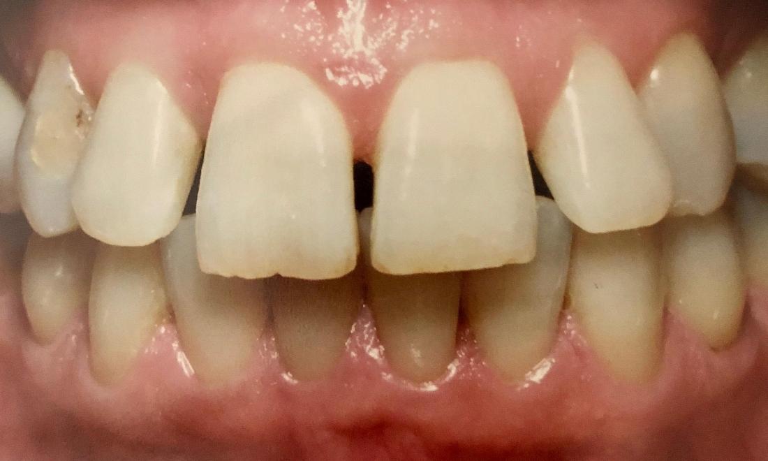 Smile Makeovers in Van Nuys | Before