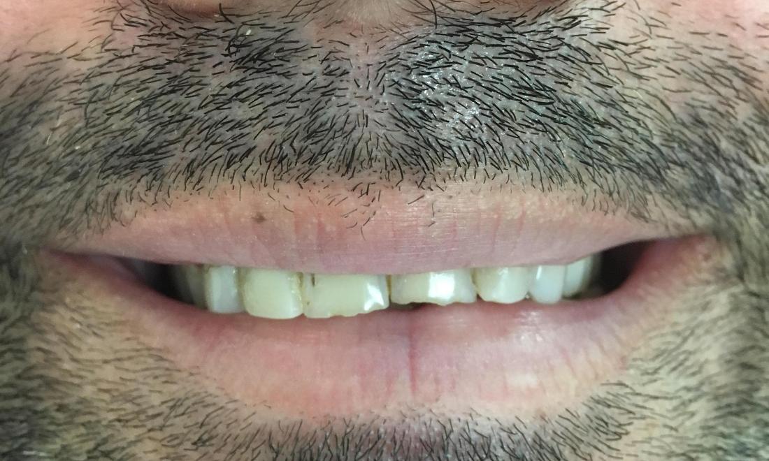 man with chipped front tooth in van nuys