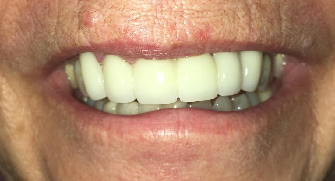 Dental Bridge in Van Nuys