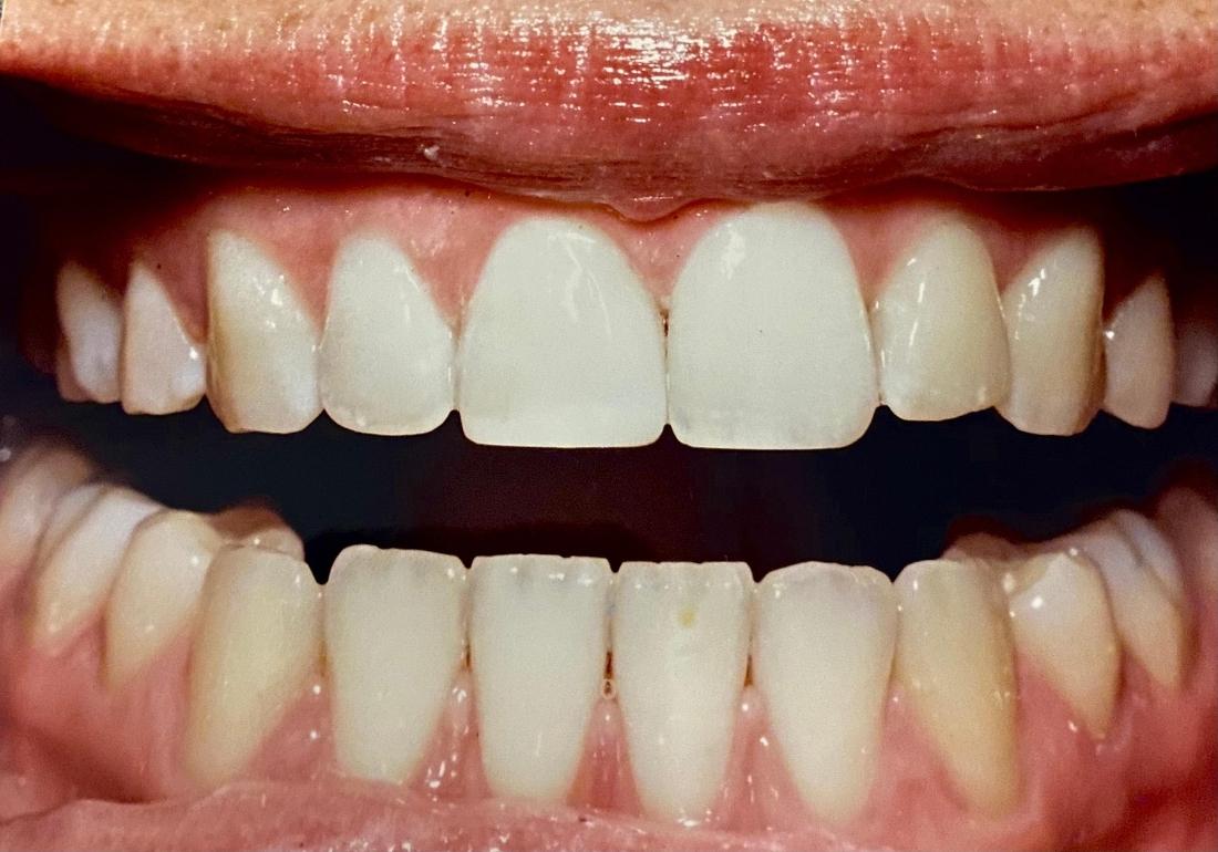Porcelain crown in Van Nuys
