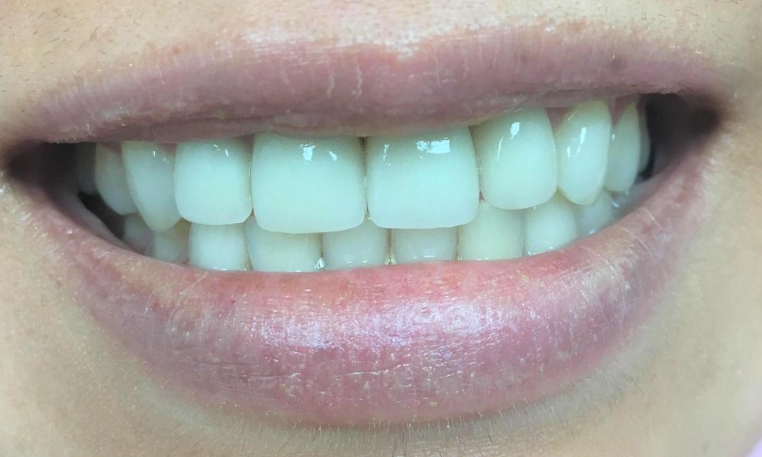 Cosmetic Dentistry Van Nuys. After Case