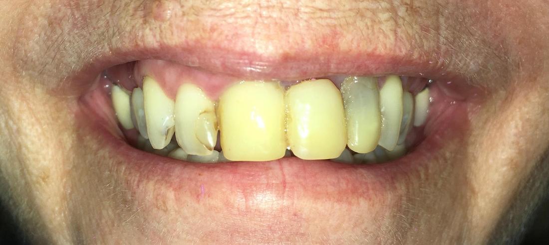 Dental Bridge in Van Nuys, CA