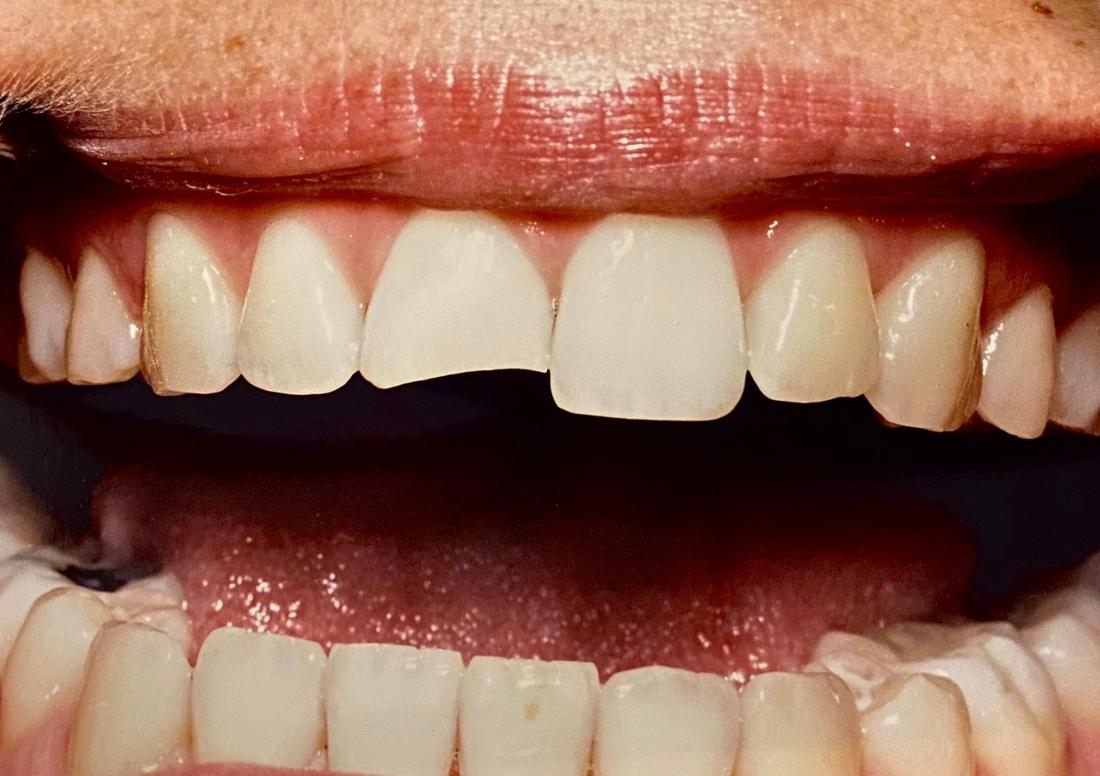 broken tooth repair in Van Nuys