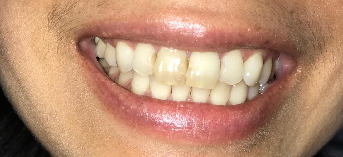 Cosmetic Dentistry Van Nuys. Before Case
