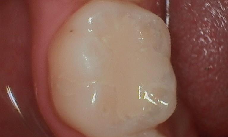 White Fillings in Van Nuys