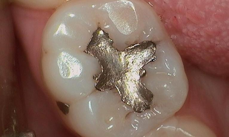 Tooth-Colored Fillings in Van Nuys